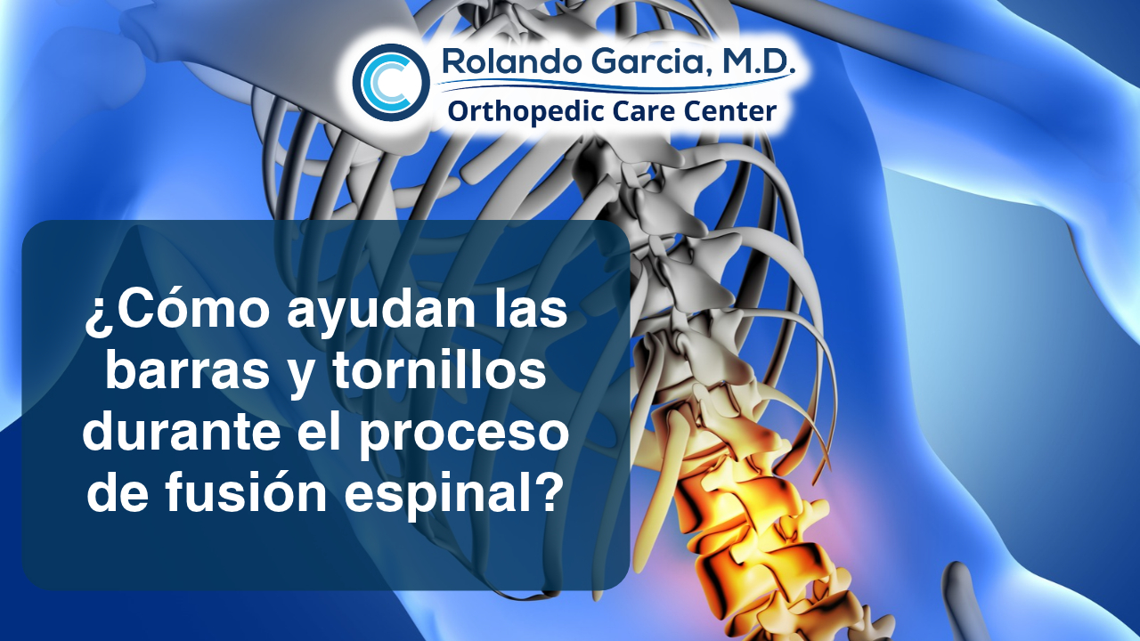 ¿Cómo ayudan las barras y tornillos durante el proceso de fusión espinal?