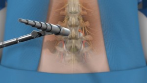 Minimally Invasive Spine Surgery