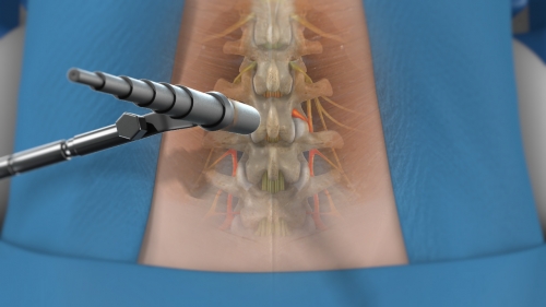 Minimally Invasive